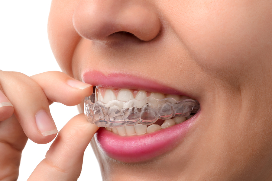 Invisalign® - Invisalign in Shawnee - Invisalign Quiz