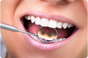braces behind your teeth